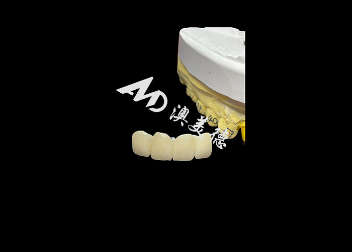 Restauración dental Corona dental de zirconia translúcida para ajuste preciso y estética natural