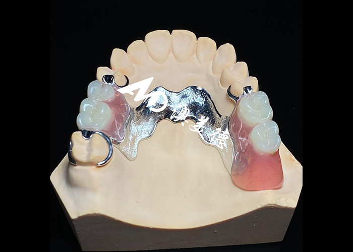 Dentadura extraíble con marco de metal fundido para una resistencia y estabilidad superiores con una comodidad duradera