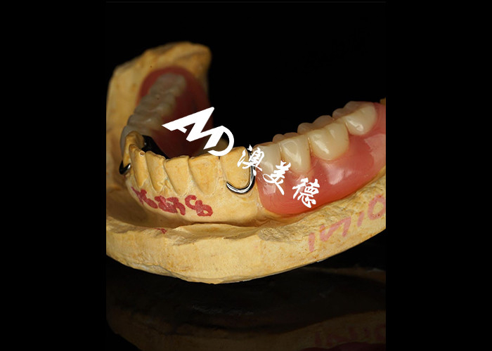 Dentadura extraíble con marco de metal fundido para una resistencia y estabilidad superiores con una comodidad duradera