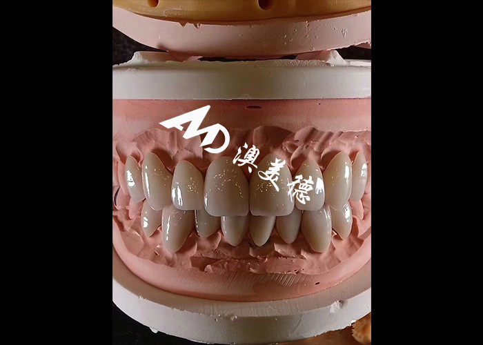 Estética Odontología EMAX Veneers dentales de 0,3-0,5 mm de espesor para restauraciones estéticas