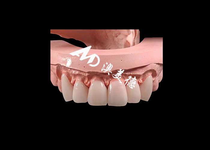 Estética Odontología EMAX Veneers dentales de 0,3-0,5 mm de espesor para restauraciones estéticas