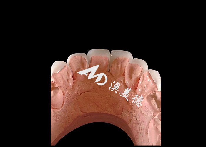 Estética Odontología EMAX Veneers dentales de 0,3-0,5 mm de espesor para restauraciones estéticas