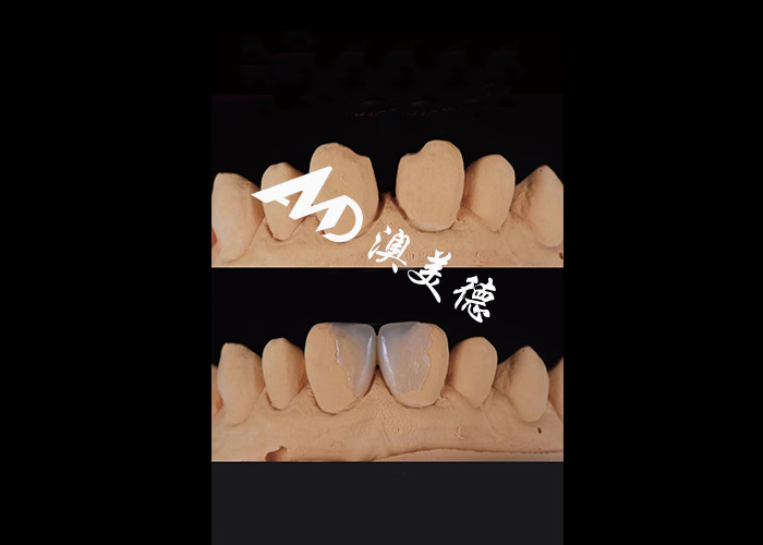 0.3-0.5mm Ultra delgado IPS EMAX Veneers de porcelana para el cambio de imagen de la sonrisa estética