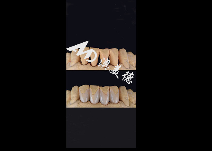 0.3-0.5mm Ultra delgado IPS EMAX Veneers de porcelana para el cambio de imagen de la sonrisa estética