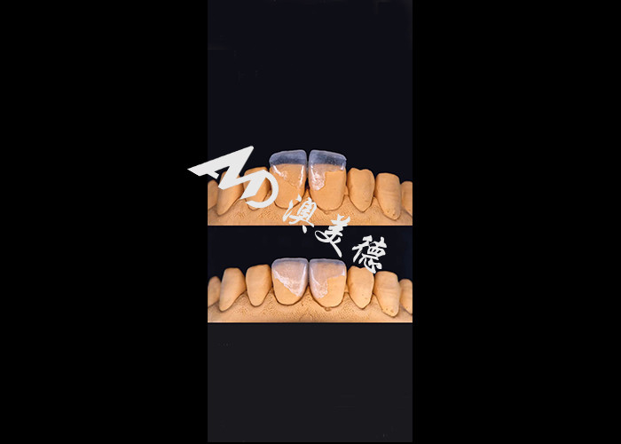 0.3-0.5mm Ultra delgado IPS EMAX Veneers de porcelana para el cambio de imagen de la sonrisa estética