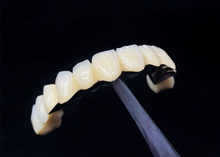 Porcelana fundida con corona de metal que combina durabilidad y belleza para la salud dental