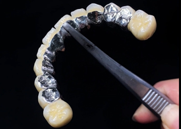 Porcelana fundida con corona de metal que combina durabilidad y belleza para la salud dental