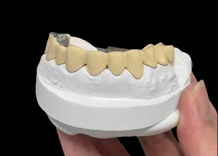 Porcelana fundida con corona de metal que combina durabilidad y belleza para la salud dental