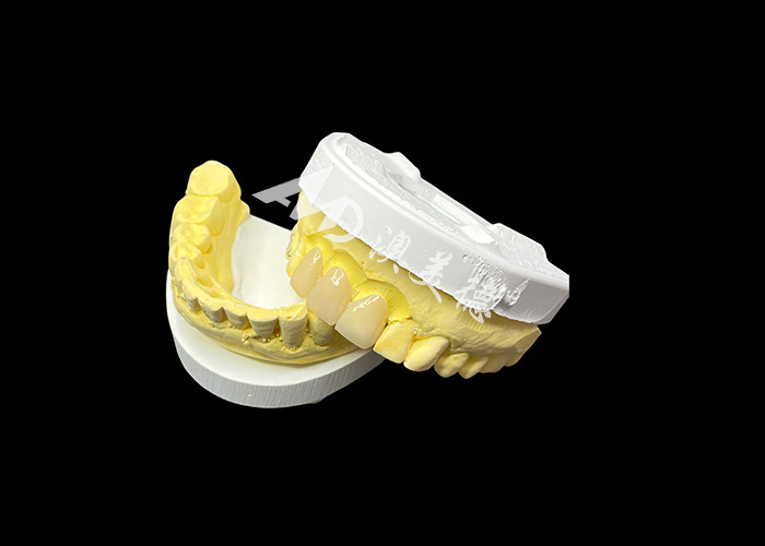 Mejore su estética dental con un puente de corona de cerámica que combina una estética excepcional y una biocompatibilidad excepcional para una sonrisa natural y cómoda