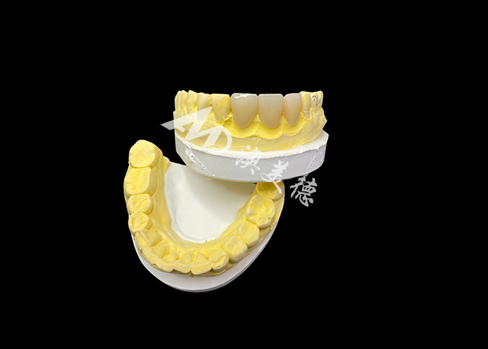 Mejore su estética dental con un puente de corona de cerámica que combina una estética excepcional y una biocompatibilidad excepcional para una sonrisa natural y cómoda