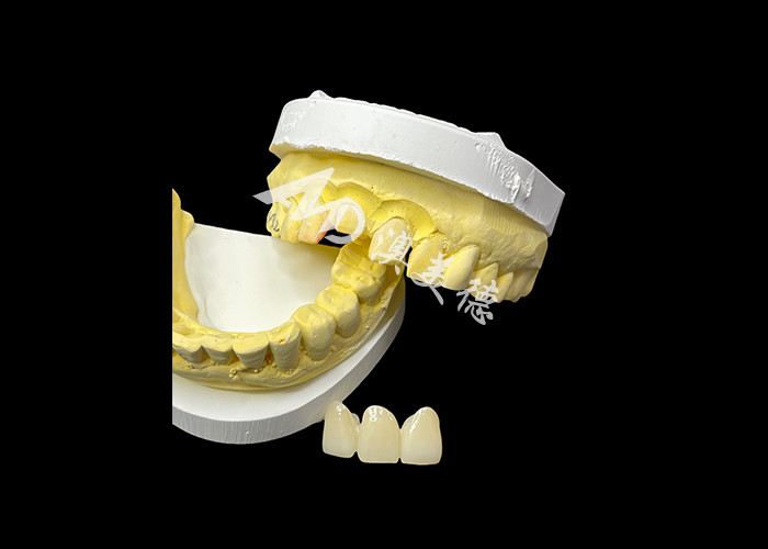 Mejore su estética dental con un puente de corona de cerámica que combina una estética excepcional y una biocompatibilidad excepcional para una sonrisa natural y cómoda