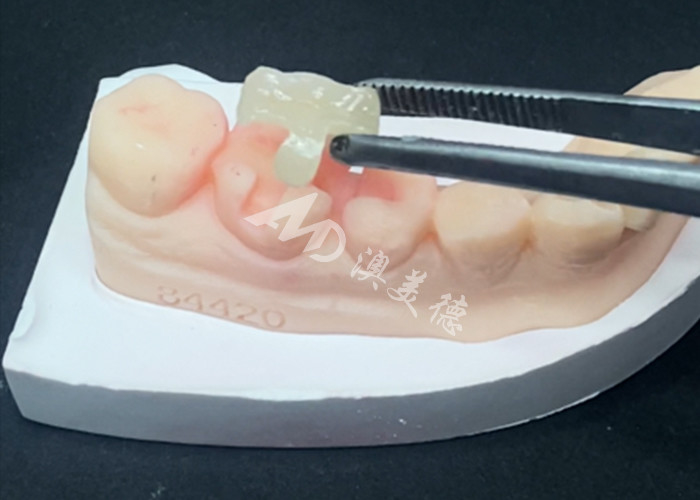 Emax Inlays Cerámicos Onlays Restauración dental para el color natural de los dientes y fácil mantenimiento