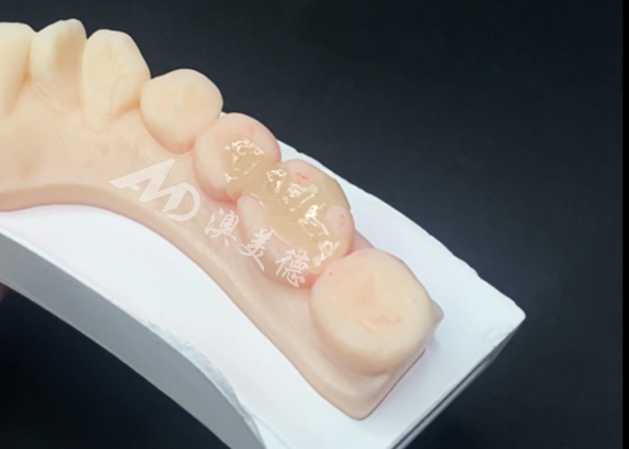 Emax Inlays Cerámicos Onlays Restauración dental para el color natural de los dientes y fácil mantenimiento