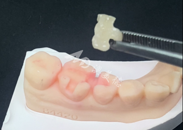 Emax Inlays Cerámicos Onlays Restauración dental para el color natural de los dientes y fácil mantenimiento