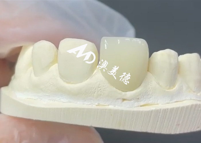 Veneer EMAX duradero y estético La solución perfecta para restauraciones de porcelana