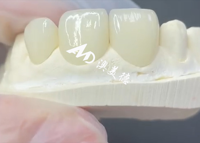 Veneer EMAX duradero y estético La solución perfecta para restauraciones de porcelana