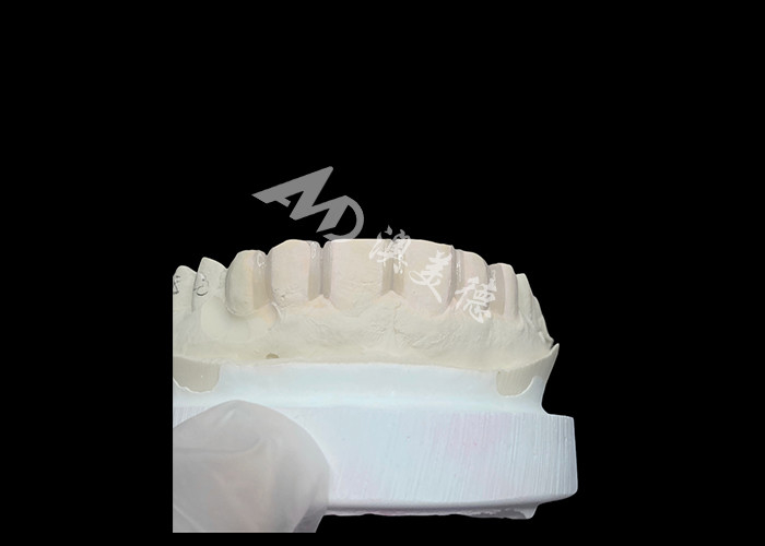 Las carillas IPS Emax con preparación mínima y sin preparación son soluciones innovadoras para una sonrisa hermosa