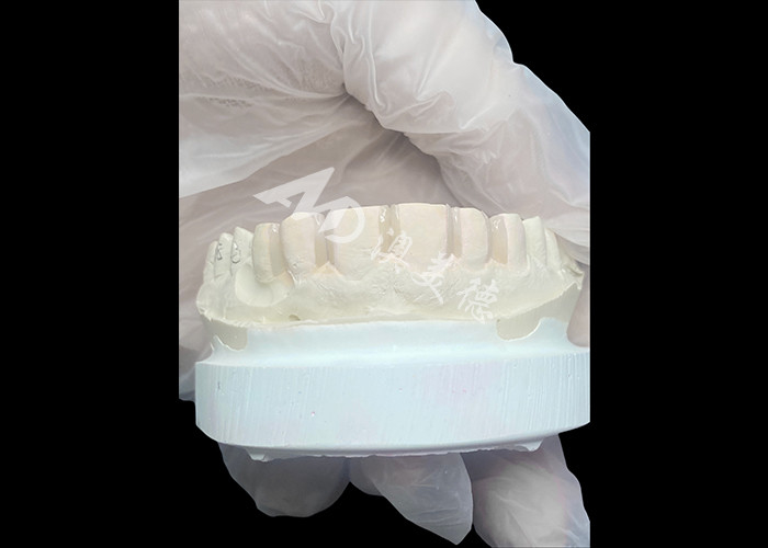 Las carillas IPS Emax con preparación mínima y sin preparación son soluciones innovadoras para una sonrisa hermosa
