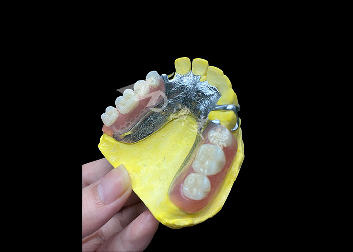 Dentes parciales de fundición ajustables para mayor comodidad y estabilidad, perfectos para masticar y hablar