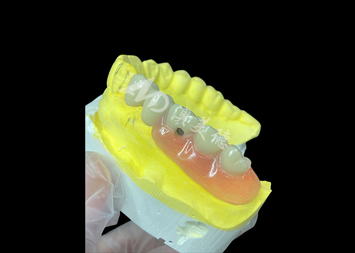 Combinación de PFM personalizada y dentaduras extraíbles La solución definitiva para la comodidad y la estética