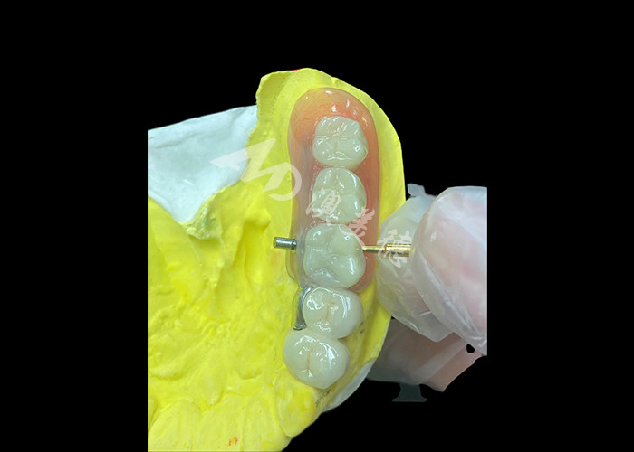Combinación de PFM personalizada y dentaduras extraíbles La solución definitiva para la comodidad y la estética