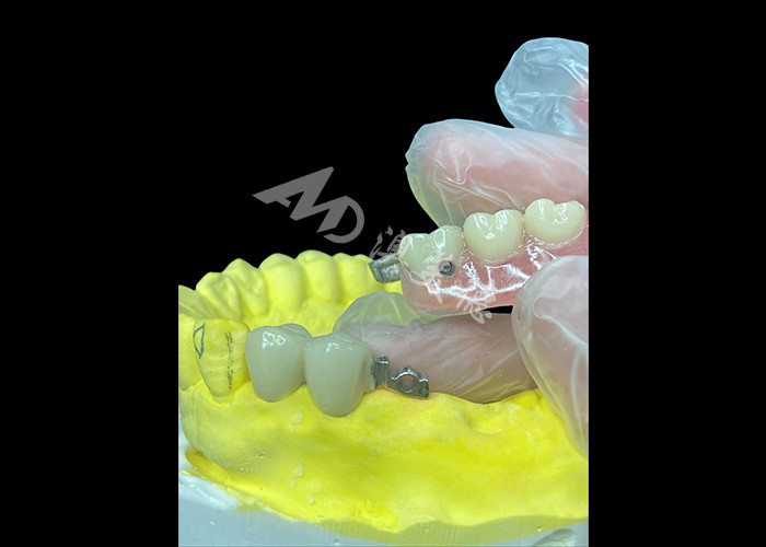 Combinación de PFM personalizada y dentaduras extraíbles La solución definitiva para la comodidad y la estética