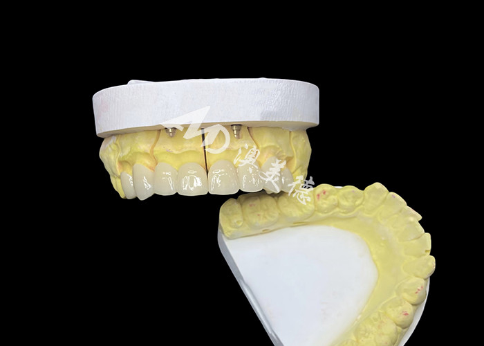 Obtenga una sonrisa perfecta con coronas dentales de cerámica de alta calidad para una apariencia natural y una fuerza duradera