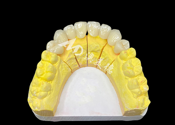 Obtenga una sonrisa perfecta con coronas dentales de cerámica de alta calidad para una apariencia natural y una fuerza duradera