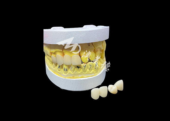 Obtenga una sonrisa perfecta con coronas dentales de cerámica de alta calidad para una apariencia natural y una fuerza duradera