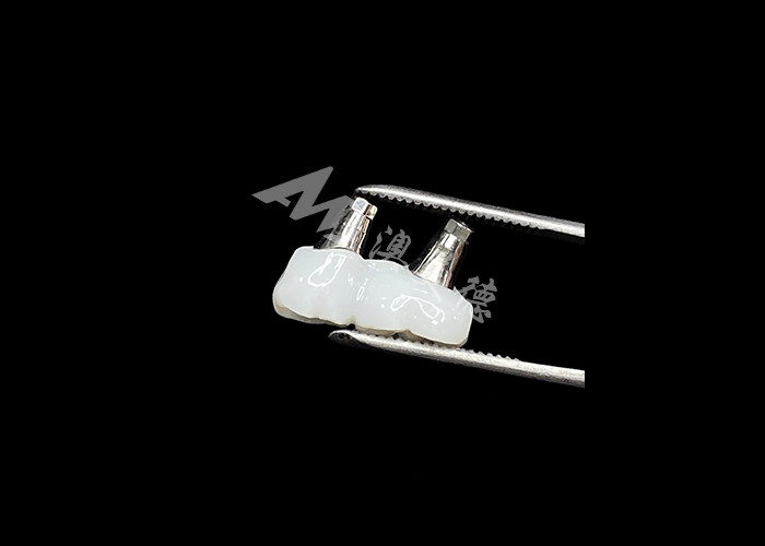 Coronas de implantes dentales de zirconia con abutment de titanio para mayor comodidad y estética