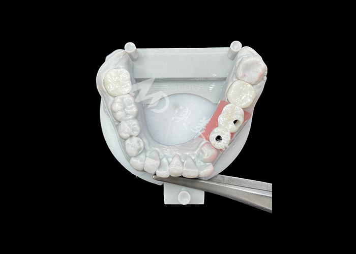 Coronas de implantes dentales de zirconia con abutment de titanio para mayor comodidad y estética