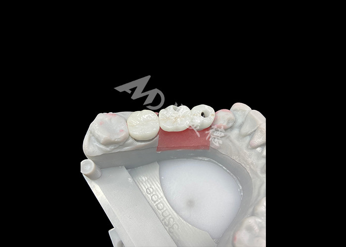Coronas de implantes dentales de zirconia con abutment de titanio para mayor comodidad y estética