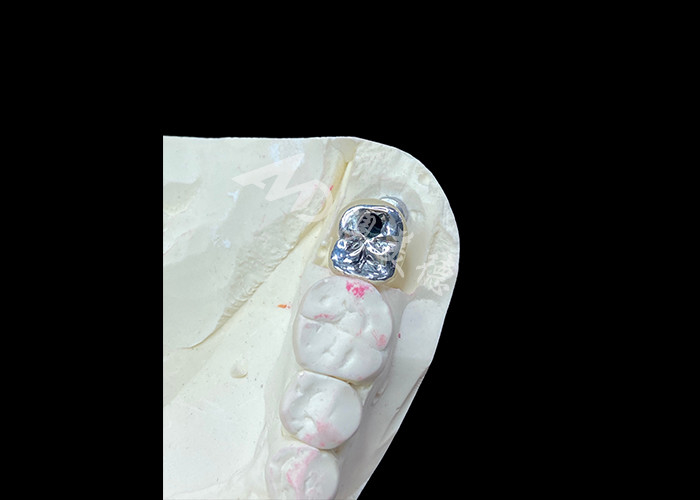 Corona de implantes dentales con abutment de titanio y corona de porcelana fundida con metal PFM
