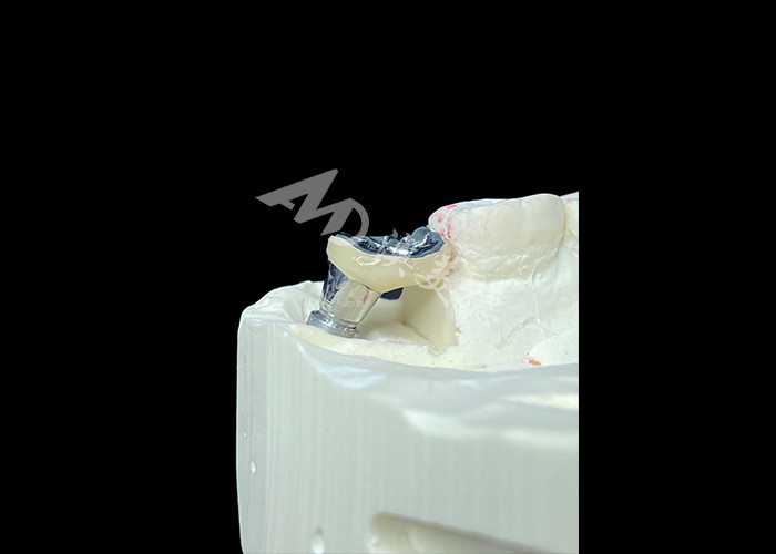 Corona de implantes dentales con abutment de titanio y corona de porcelana fundida con metal PFM