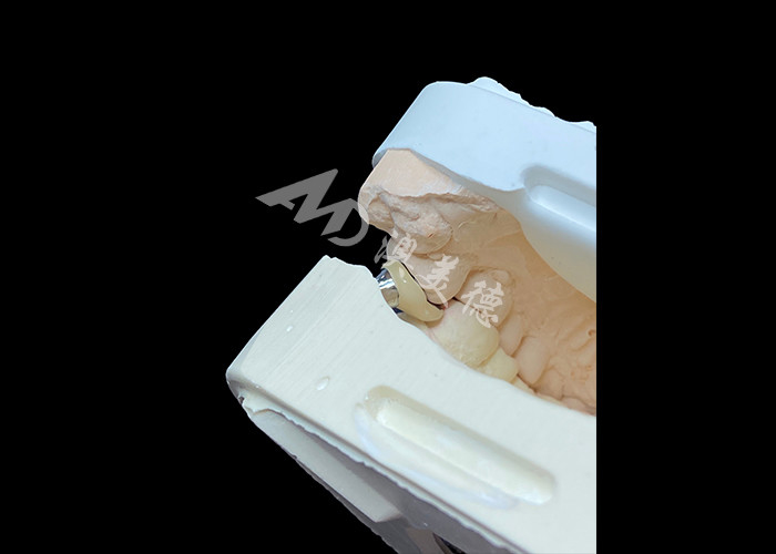 Corona de implantes dentales con abutment de titanio y corona de porcelana fundida con metal PFM