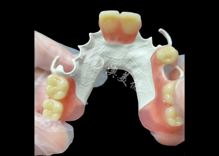 Estética de la prótesis dental parcial extraíble hecha a medida Marco HPP para el reemplazo de dientes parciales naturales