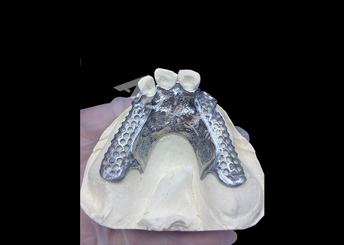 Fácil de ajustar Custom Cast Partial Denture Marco estable y de aspecto natural para resultados rápidos