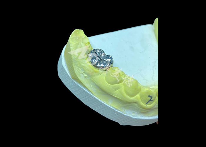 Función duradera Corona fundida de metal durable para restauración dental superior