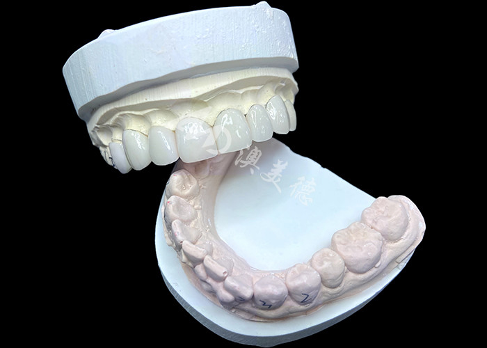 Las carillas IPS e.max en sombreado BL2 logran una estética natural impresionante con 8 unidades perfectamente elaboradas