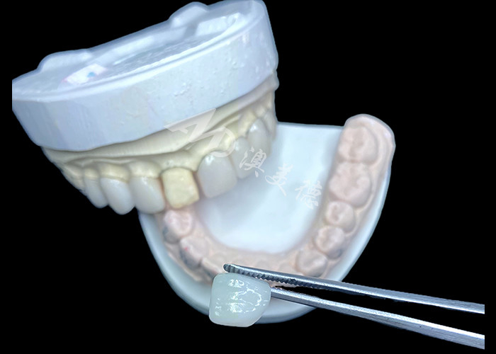 Las carillas IPS e.max en sombreado BL2 logran una estética natural impresionante con 8 unidades perfectamente elaboradas