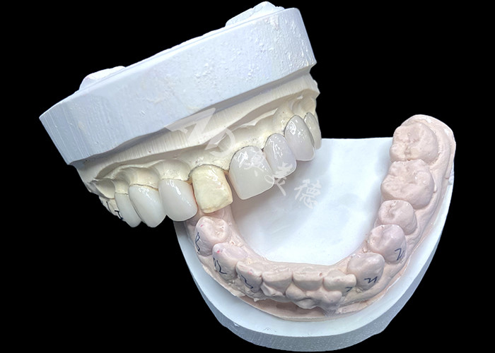 Las carillas IPS e.max en sombreado BL2 logran una estética natural impresionante con 8 unidades perfectamente elaboradas