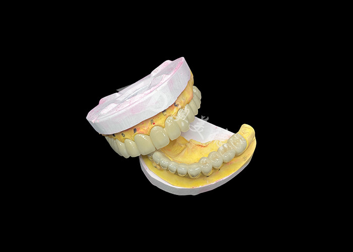 Porcelana personalizada fusionada con puente de corona dental de metal para mejorar la sonrisa natural