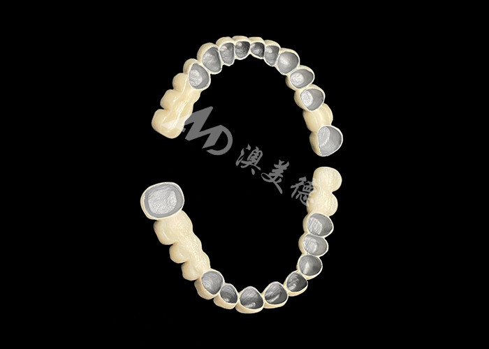 Porcelana personalizada fusionada con puente de corona dental de metal para mejorar la sonrisa natural