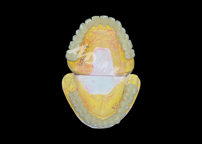 Porcelana personalizada fusionada con puente de corona dental de metal para mejorar la sonrisa natural