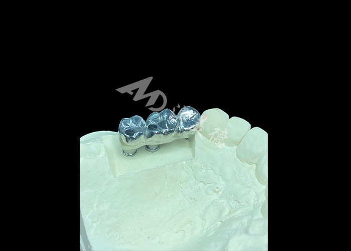 Implantes dentales de corona de titanio de pleno molde de larga duración para reemplazo de dientes perdidos