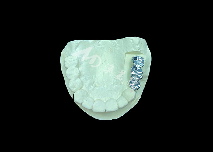 Implantes dentales de corona de titanio de pleno molde de larga duración para reemplazo de dientes perdidos