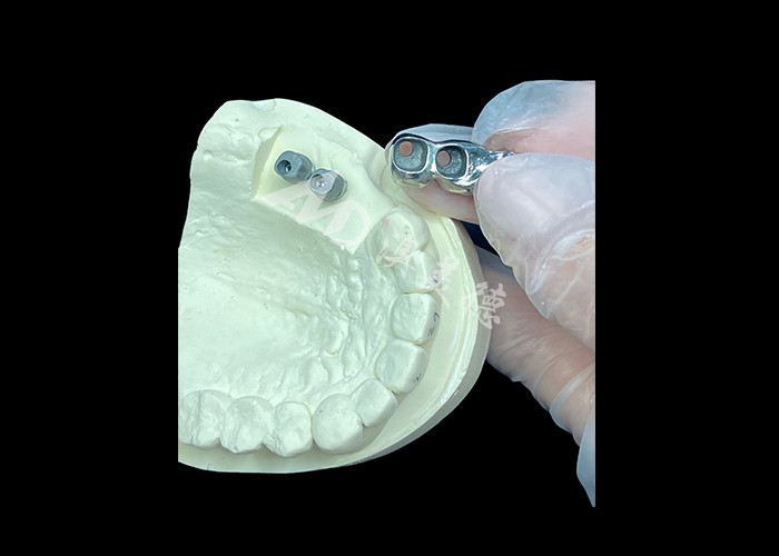 Implantes dentales de corona de titanio de pleno molde de larga duración para reemplazo de dientes perdidos