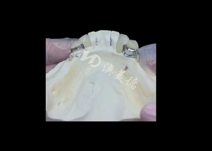 Porcelana duradera fundida a la corona dental de metal PFM corona para la restauración