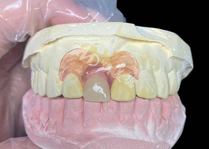 Prótese parcial flexible de Nesbit para incisivos que ofrece una solución de reemplazo de dientes extraíbles sin costuras