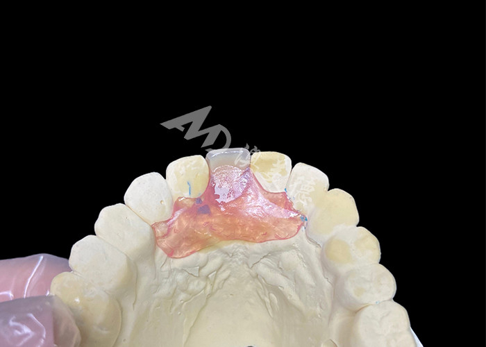 Prótese parcial flexible de Nesbit para incisivos que ofrece una solución de reemplazo de dientes extraíbles sin costuras